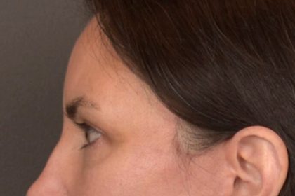 Brow Lift Before & After Patient #3964