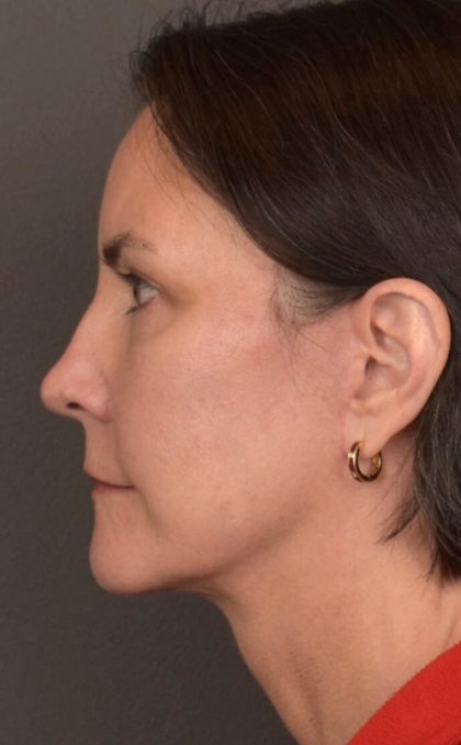 Facial Fat Grafting Before & After Patient #3965
