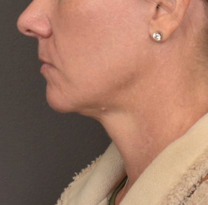 Neck Lift Before & After Patient #4015