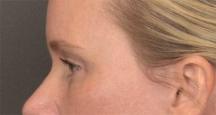 Blepharoplasty Before & After Patient #4016