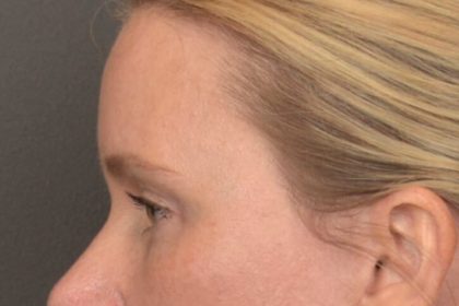 Brow Lift Before & After Patient #4017