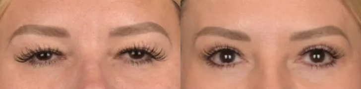 Blepharoplasty