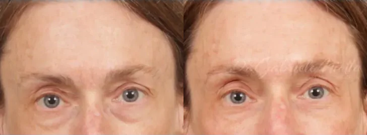 Botox
