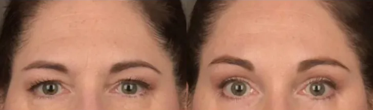 Brow Lift