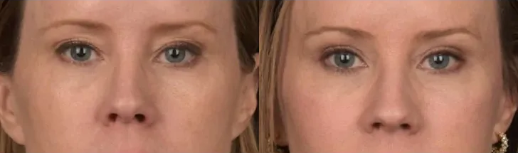Facial Fat Grafting