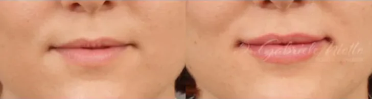 Lip Augmentation