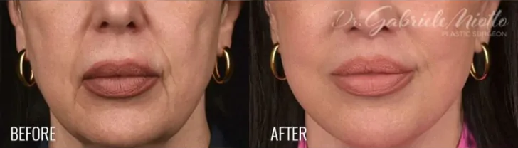 Lip Lift
