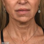 Neck Lift Before & After Patient #3816