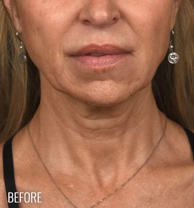 Neck Lift Before & After Patient #3816