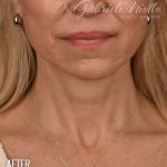 Neck Lift Before & After Patient #3816