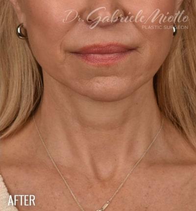Neck Lift Before & After Patient #3816