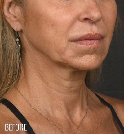 Neck Lift Before & After Patient #3816