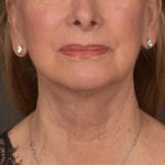 Neck Lift Before & After Patient #3664