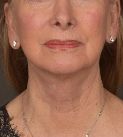 Neck Lift Before & After Patient #3664