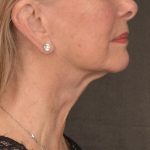 Neck Lift Before & After Patient #3664