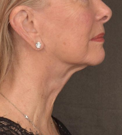 Neck Lift Before & After Patient #3664