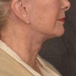 Neck Lift Before & After Patient #3664