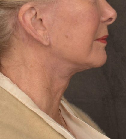 Neck Lift Before & After Patient #3664