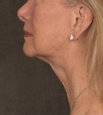 Neck Lift Before & After Patient #3664