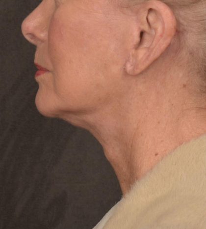 Neck Lift Before & After Patient #3664