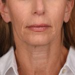 Neck Lift Before & After Patient #3653