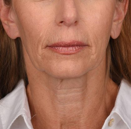 Neck Lift Before & After Patient #3653