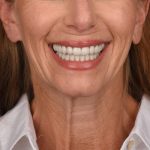 Neck Lift Before & After Patient #3653