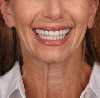 Neck Lift Before & After Patient #3653