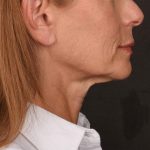 Neck Lift Before & After Patient #3653