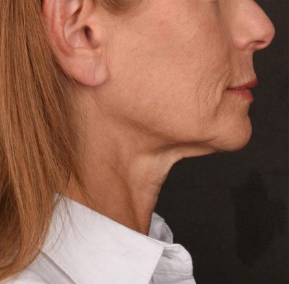 Neck Lift Before & After Patient #3653