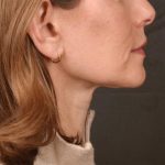 Neck Lift Before & After Patient #3653