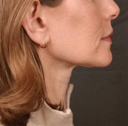 Neck Lift Before & After Patient #3653