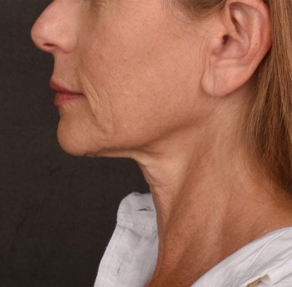 Neck Lift Before & After Patient #3653