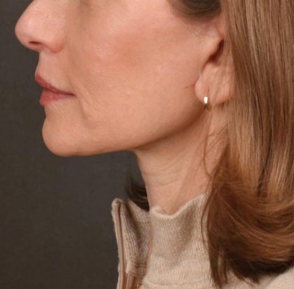 Neck Lift Before & After Patient #3653