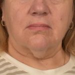 Neck Lift Before & After Patient #3665