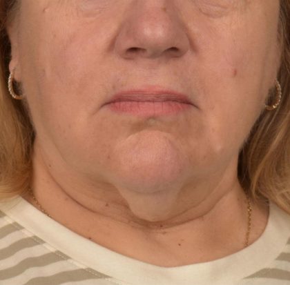 Neck Lift Before & After Patient #3665