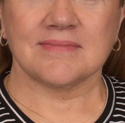 Neck Lift Before & After Patient #3665
