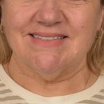 Neck Lift Before & After Patient #3665