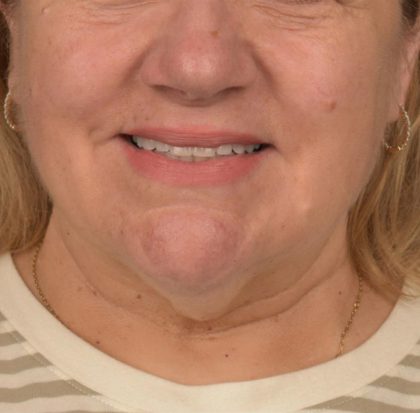 Neck Lift Before & After Patient #3665