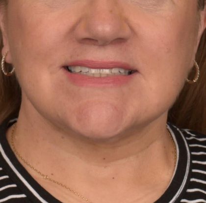 Neck Lift Before & After Patient #3665