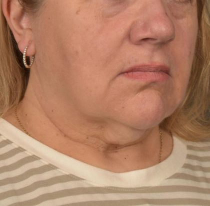 Neck Lift Before & After Patient #3665