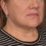 Neck Lift Before & After Patient #3665