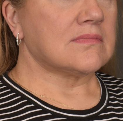 Neck Lift Before & After Patient #3665