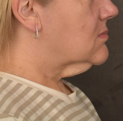 Neck Lift Before & After Patient #3665