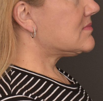 Neck Lift Before & After Patient #3665