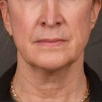 Neck Lift Before & After Patient #3666