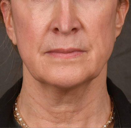 Neck Lift Before & After Patient #3666