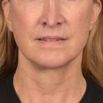 Neck Lift Before & After Patient #3666