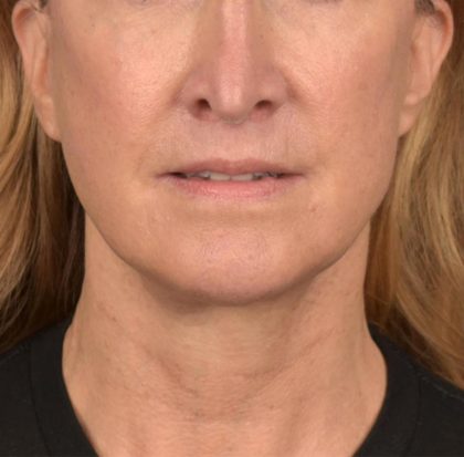 Neck Lift Before & After Patient #3666