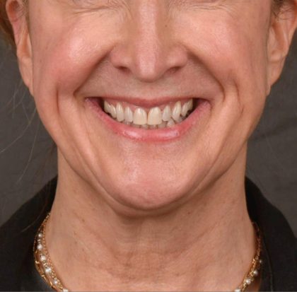 Neck Lift Before & After Patient #3666